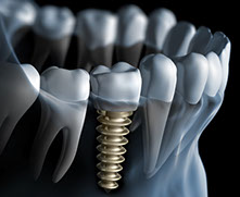 Dental Implants