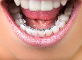 Ortodoncia Lingual