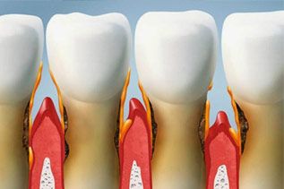 Piorrea Periodontal